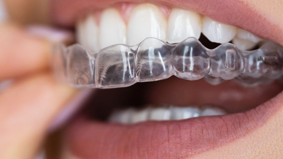 Discover How Clear Aligners Change Smiles
